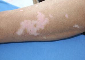 手臂上长白斑的原因,我不说你知道吗?