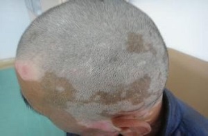 父母老了,白癜风你别伤害他们!