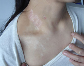 白癜风患者长期熬夜危害大吗?