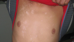 想治好胸部白癜风这几点事项要注意