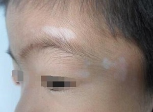 孩子挑食不爱吃青菜会长白癜风吗?