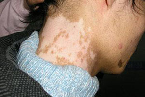 颈部白癜风原因