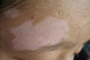 老年人白癜风的病因是什么呢?