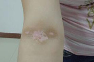 白癜风发展成泛发型有哪些症状?