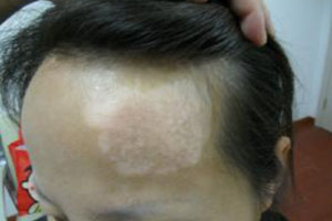 头部白癜风如何挑选洗发水