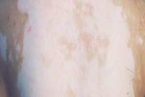 白癜风的治疗有哪些要点?