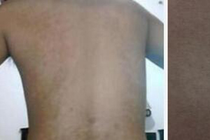 昆明医治白癜风哪家好?