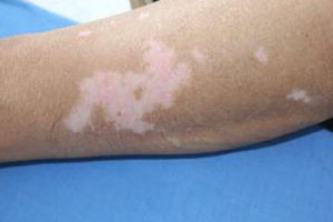 白癜风有哪些共同的症状特征