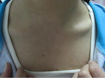 花季少女结束2年白斑摧残