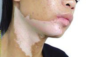 三大妙招搞定颈部白癜风