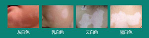 白癜风不同白斑颜色治疗方法不同