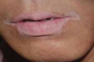 唇边的白斑用他克莫司能好吗