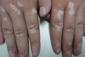 肢端型白癜风 冬天不可疏忽