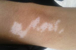 白癜风照激光没发红怎么办