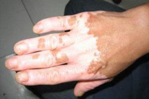 创伤性白癜风会自愈吗