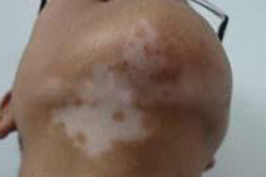 昆明白癜风医生介绍颈部白斑病因